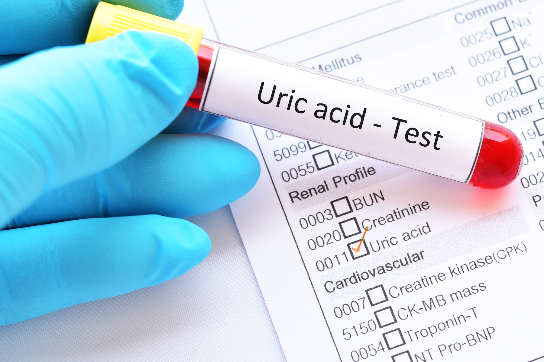 high uric acid test